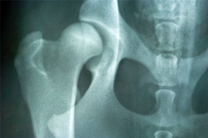 рентгеновский снимок дисплазии тазобедренного сустава